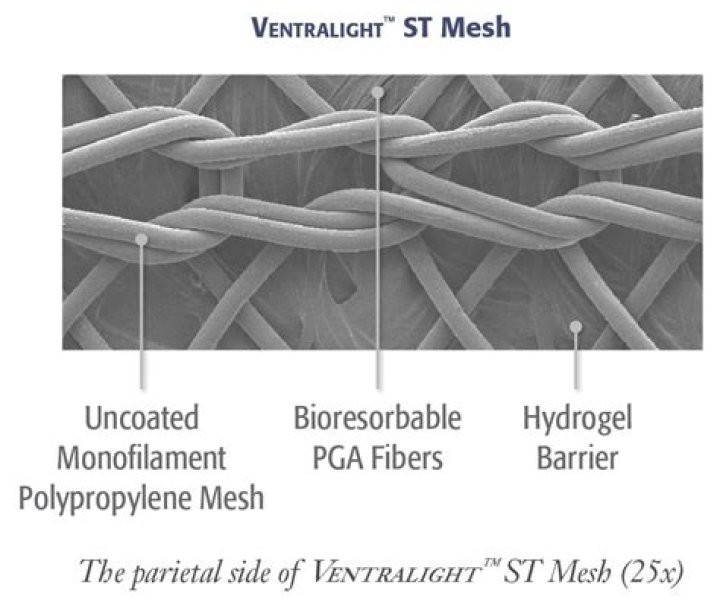 What is Ventralight mesh?