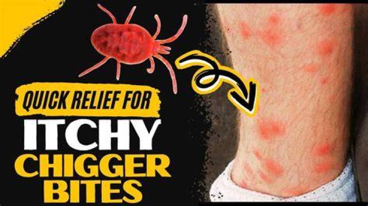 What kills chiggers on skin?