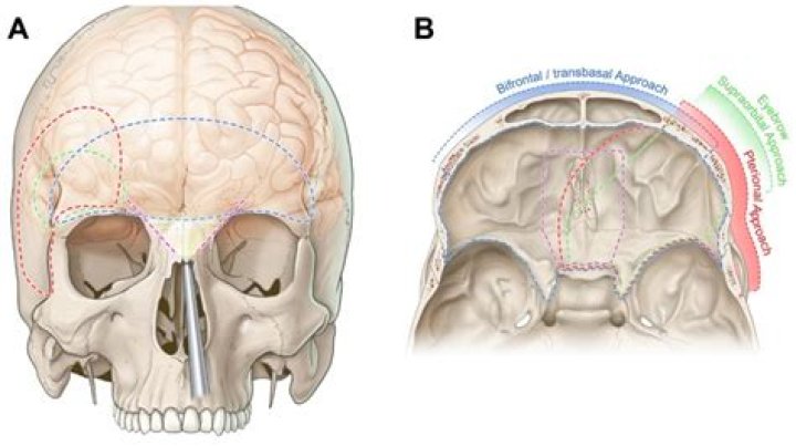 What kind of fracture is a complete craniofacial separation