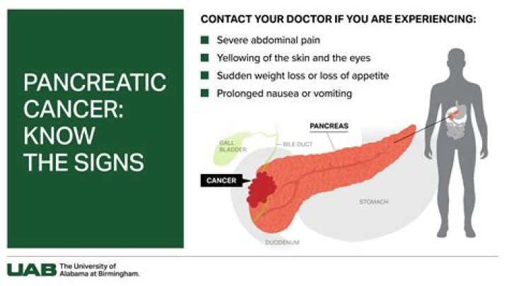 Where does cancer usually begin in the pancreas?