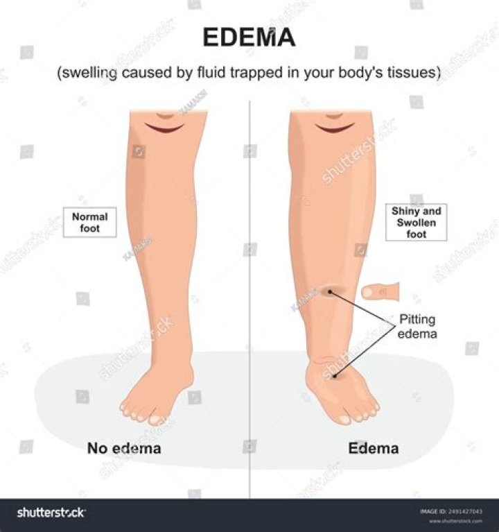 Where does Oedema occur? | ContextResponse.com