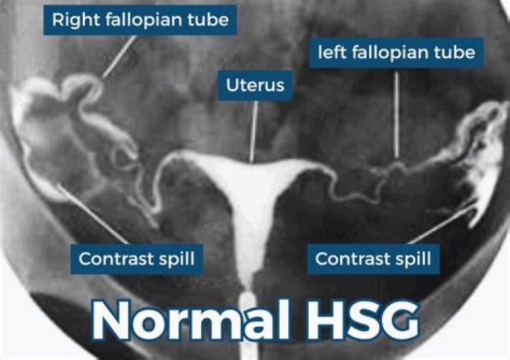 Which contrast is used for HSG investigation?
