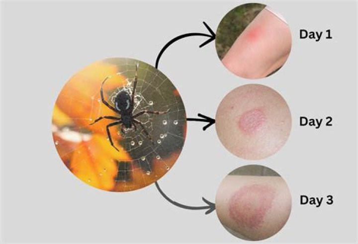 Which may be a typical clinical feature of a black widow spider bite?