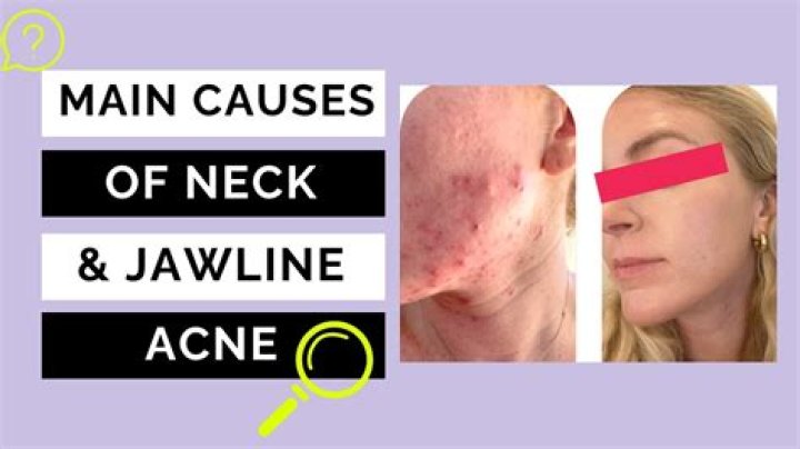 Why am I getting spots on my jawline?
