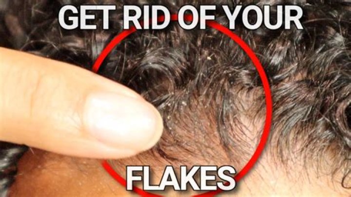 Why are there white flakes in my hair?