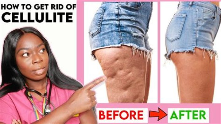 Why do I see more cellulite after losing weight?