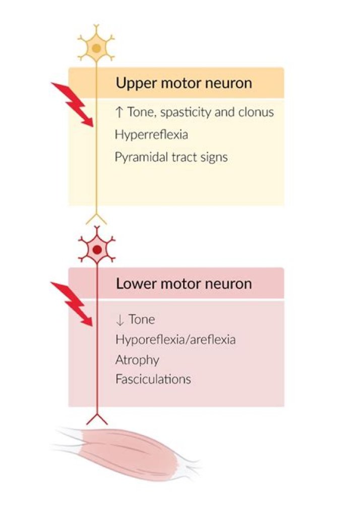 Why do you get Hyperreflexia in upper motor neuron lesions?